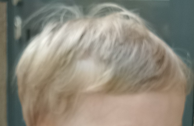 Was würdet ihr sagen wie lange es dauert bis diese Lücke zugewachsen ist? Frage für den Kindergartenfotografen, der in zwei Wochen kommt.🙃