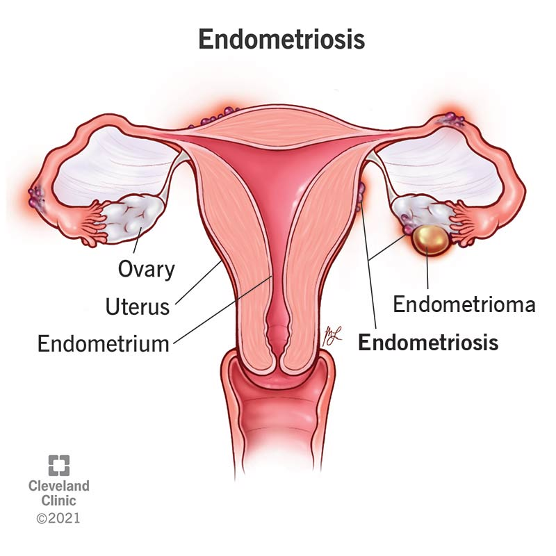 clinicKe's tweet photo. Endometriosis is a chronic condition that occurs when tissue similar to the lining of the uterus grows outside of the uterus. It can cause severe pain in the pelvis, heavy and painful periods, pain during sex, and infertility. Endometriosis can start at menache to menopause. https://t.co/F9wB5Du1ix