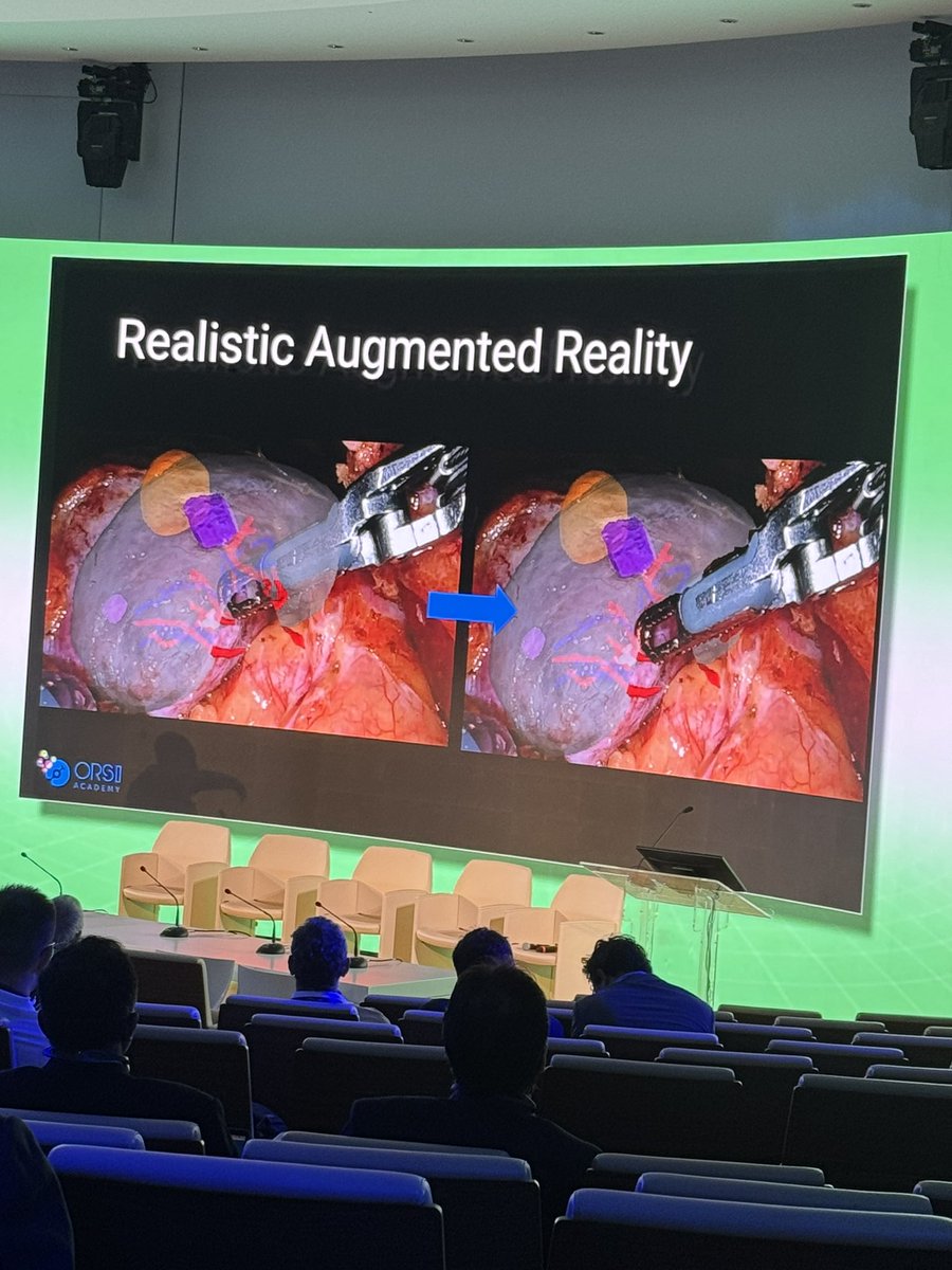 DrOrcunCelik's tweet photo. Real time Augmented Reality with AI !!it is amazing especially for partial nephrectomy👏@CILR2024 https://t.co/IbY58sVjKp