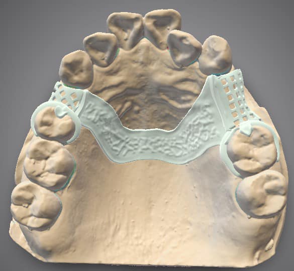 We Attenborough Dental do crown and bridge, partial chrome, denture, bite splint and post and core all digitally. Please email info@attenborough.com for more details.
#attenboroughmedical
#attenboroughdental