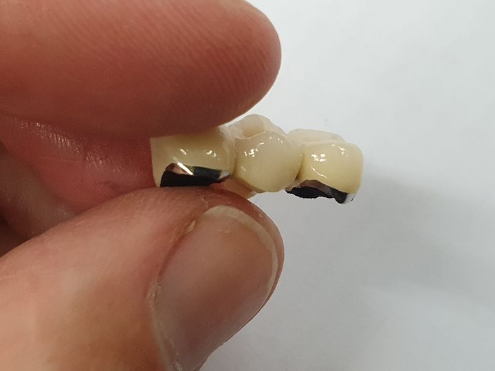 Nice PFM bridge today #attenboroughden #attenboroughmedical #attenboroughdental