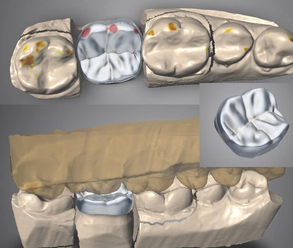 We Attenborough Dental do crown and bridge, partial chrome, denture, bite splint and post and core all digitally. Please email info@attenborough.com for more details.
#attenboroughmedical
#attenboroughdental