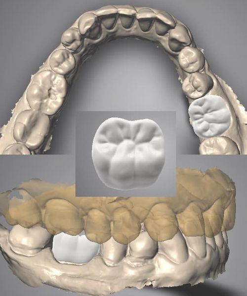 We Attenborough Dental do crown and bridge, partial chrome, denture, bite splint and post and core all digitally. Please email info@attenborough.com for more details.
#attenboroughmedical
#attenboroughdental