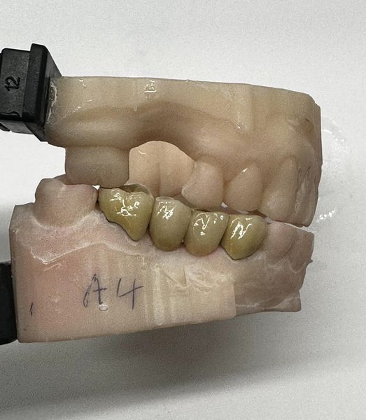 Beautiful porcelain work today!
Attenborough Dental
Attenborough Medical
#attenboroughmedical
#attenboroughdental