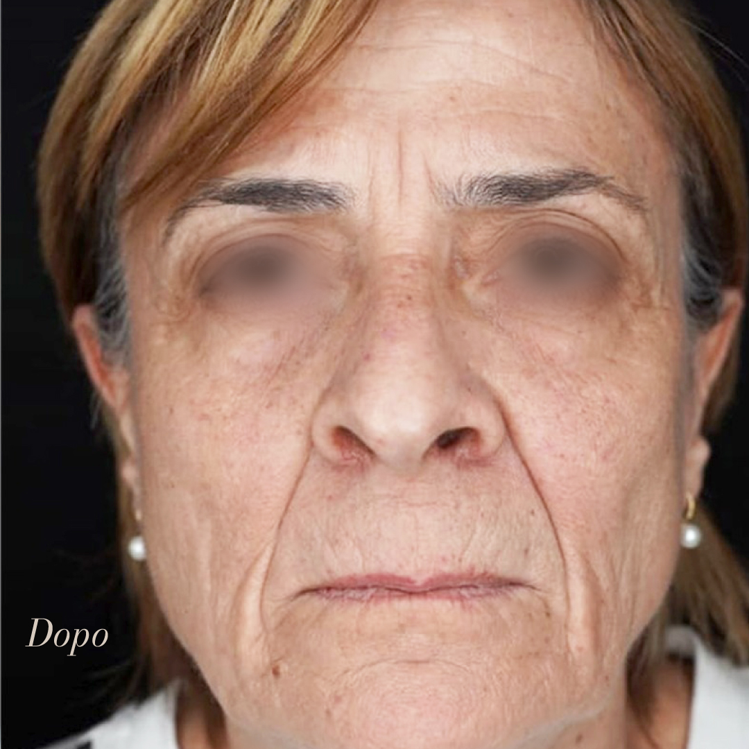 FaustoRispoli's tweet photo. Il lipofilling facciale, è una procedura di chirurgia estetica che impiega il grasso del paziente per il ripristino dei volumi del viso.
Nel caso illustrato notiamo un  ripristino dei compartimenti adiposi superficiali.

Prenota ora
MOLISE 📞 0875703758
SICILIA 📞 0909024790 https://t.co/6raxXdXYhR