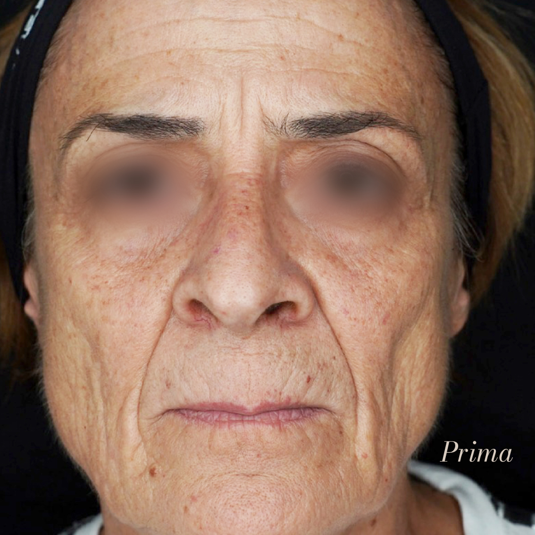 FaustoRispoli's tweet photo. Il lipofilling facciale, è una procedura di chirurgia estetica che impiega il grasso del paziente per il ripristino dei volumi del viso.
Nel caso illustrato notiamo un  ripristino dei compartimenti adiposi superficiali.

Prenota ora
MOLISE 📞 0875703758
SICILIA 📞 0909024790 https://t.co/6raxXdXYhR