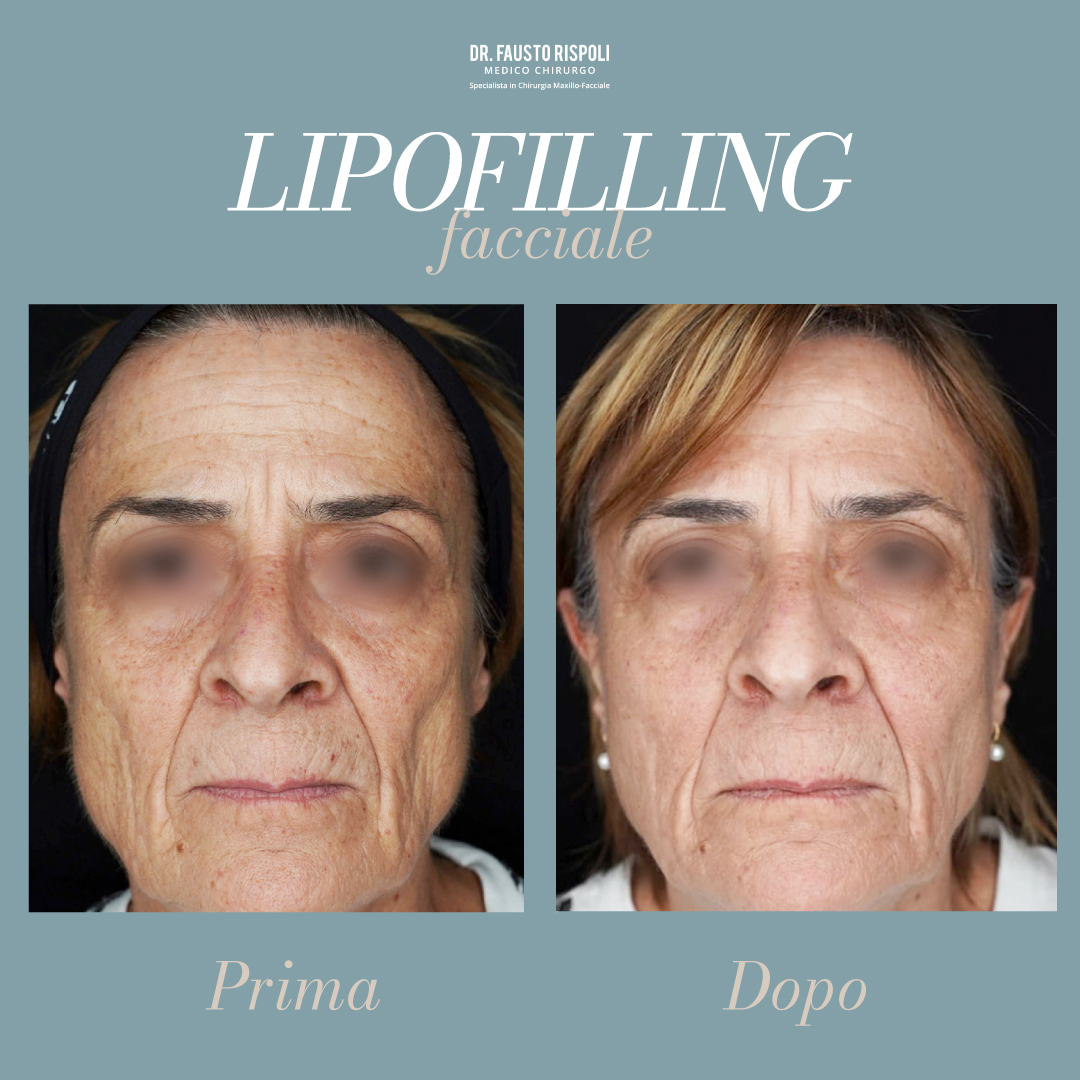 FaustoRispoli's tweet photo. Il lipofilling facciale, è una procedura di chirurgia estetica che impiega il grasso del paziente per il ripristino dei volumi del viso.
Nel caso illustrato notiamo un  ripristino dei compartimenti adiposi superficiali.

Prenota ora
MOLISE 📞 0875703758
SICILIA 📞 0909024790 https://t.co/6raxXdXYhR