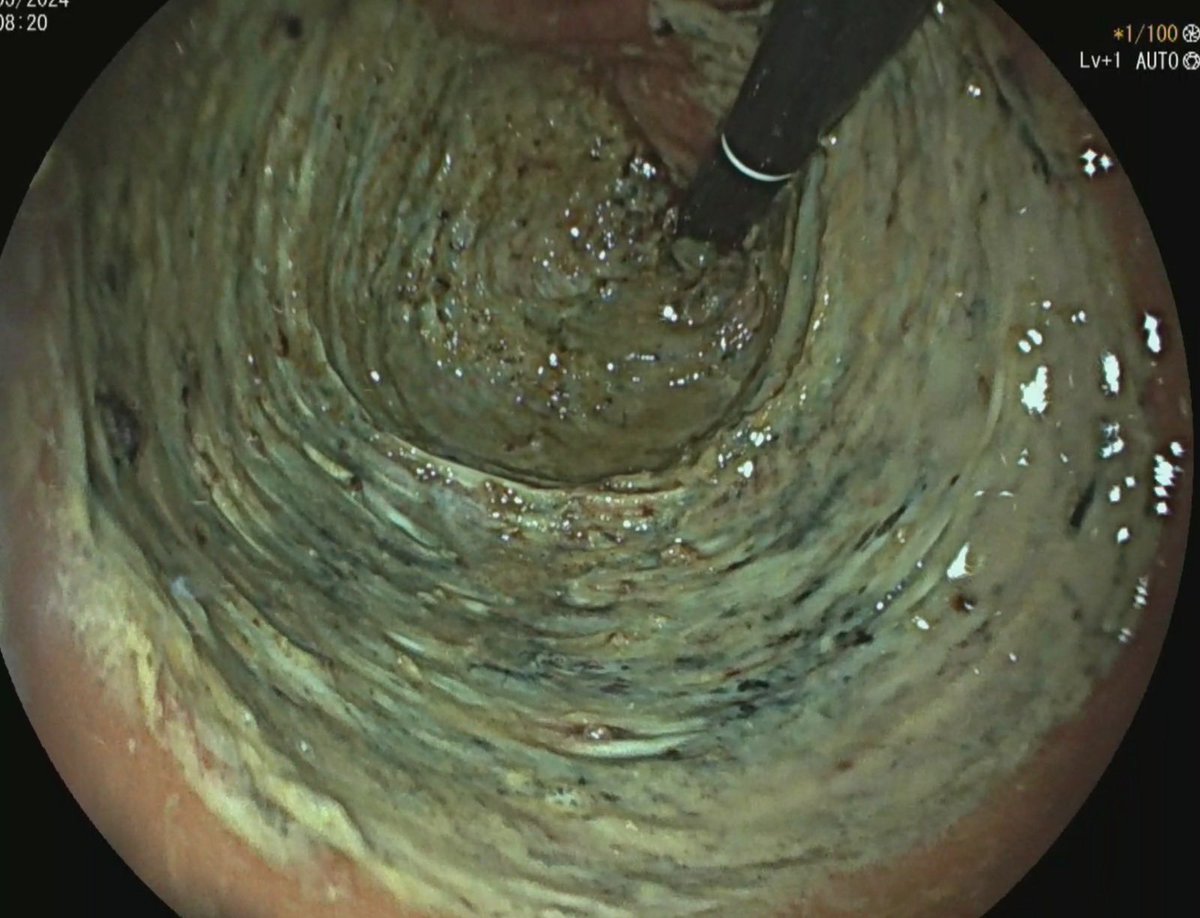 20 cm (75% circum)Rectal LST. Took 10 hours. Pt happy but anaesthetist don’t want to work with me ever again!!! <a href="/EndoscopyOA/">Endoscopy On Air</a> to learn from masters! Join me today &amp;share pearls of wisdom. <a href="/alerepici/">alessandro repici</a> <a href="/robertamaselli1/">roberta maselli</a>