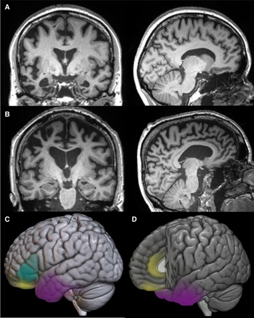 mrccbu's tweet image. New paper: A neuroanatomical and cognitive model of impaired social behaviour in frontotemporal dementia: doi.org/10.1093/brain/…