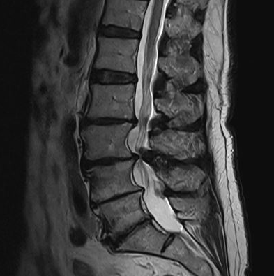 TDekkersPhysio's tweet photo. The human body never ceases to amaze me 🤯

79 year old with severe spinal canal stenosis at L3/4 &amp; extensive disc degeneration in lower 4 discs.....completely asymptomatic, walking unrestricted and enjoying life 🙌 https://t.co/bA2O9Gk8aX