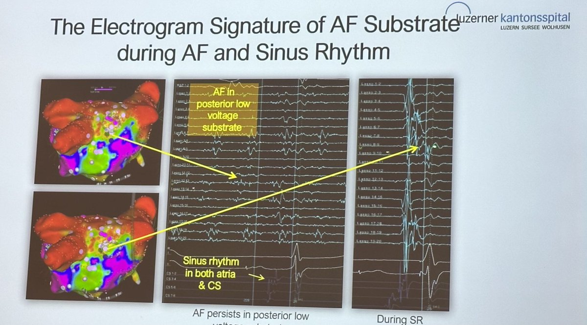 S_NarayanMD's tweet photo. Atrial #latepotentials in sinus rhythm sites of continuous #fractionation in #afib, where #ablation terminated #AF improved outcome. Great work! @ Amit Jadidi @nmarrouche @jongichun @ Julien Seitz @atulverma_md @ShaojieChen1 #AtrialSignals 2024 https://t.co/EHMeeni9ZX
