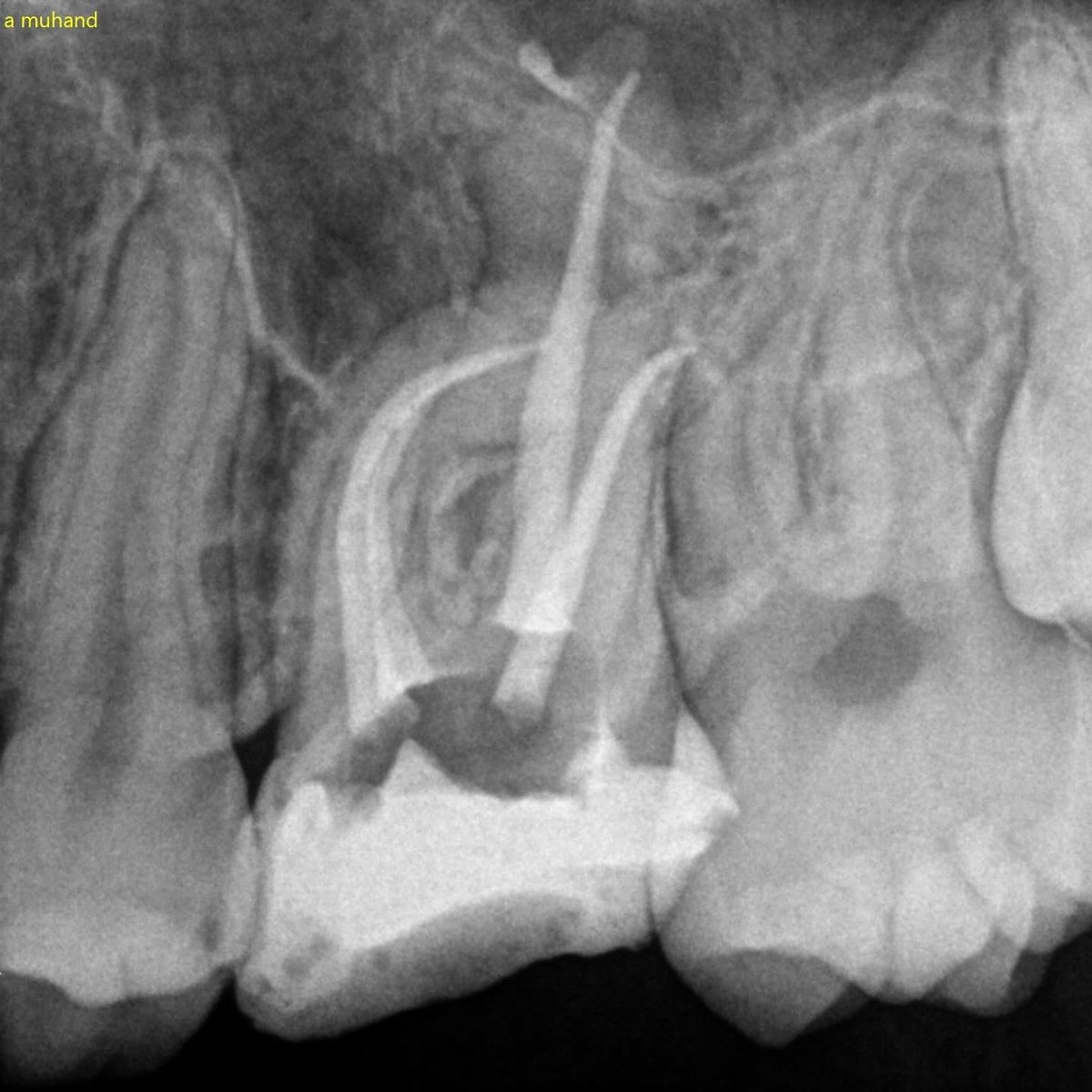 #26 with 4 canals🧼