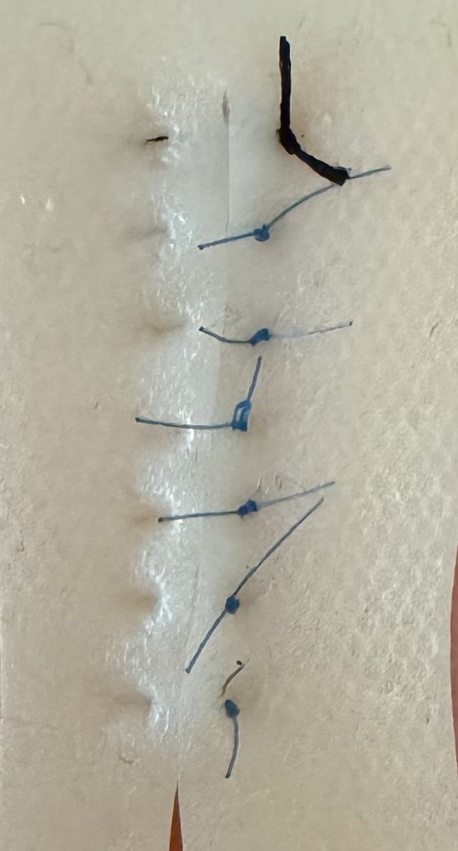 DoctorPetruzzo's tweet photo. These are some of the first vertical mattress sutures I ever did- they’re also a great example of what NOT to do! See how you can’t even see the blue material on the left? This is because the stitch is too tight, and would also make removing it harder in the future. More soon :) https://t.co/Fz6DYqwnwt