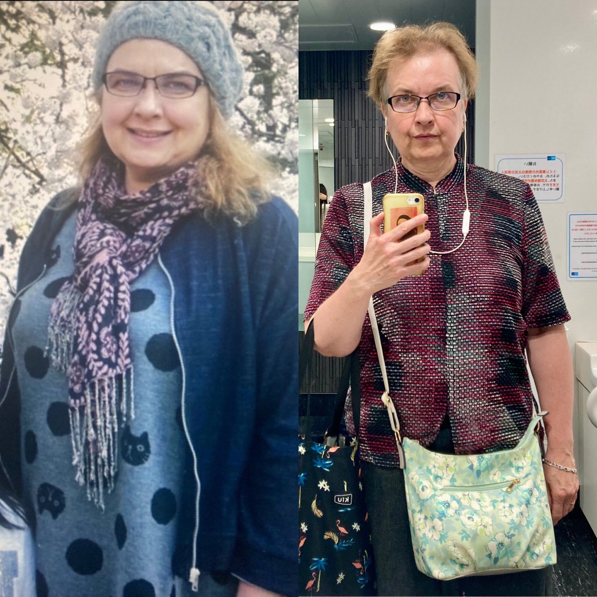 paulaannev's tweet photo. Continuing to lose weight. Even the best clinicians have no time for the mentally ill. We have to rely on ourselves. #BolloxToBariatrics #ShawSomers #GuySlater #GavinQuinton #StreamlineSurgical #BOMSS #IFSO #Charlatons #SystemicPrejudice #SystemicDiscrimination #IllNotEvil https://t.co/1rdalOJrgD