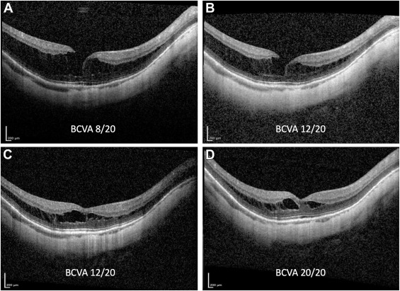 AAOjournal's tweet photo. High myopia patient with outer maculoschisis. Conservative management led from BCVA 8/20 to 20/20. The case highlights importance of precise surgical criteria for myopic maculopathy #EyeHealth @rodrigofnarros https://t.co/UkALotAW1p https://t.co/nCcRxB4zFl