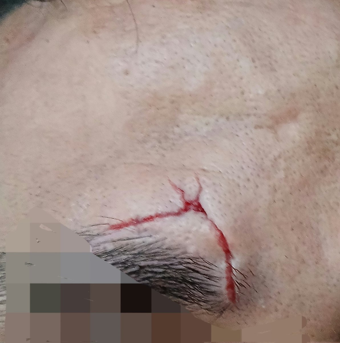 23An18's tweet photo. The art of deep dermal sutures (inverted)🎨 https://t.co/mCixNHYEng
