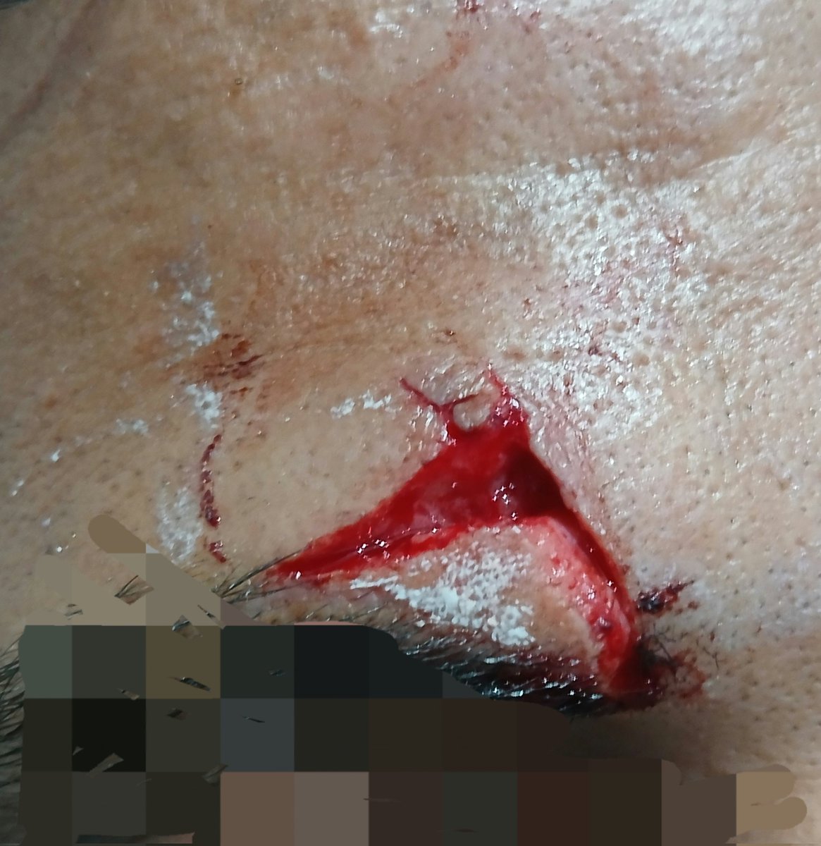 23An18's tweet photo. The art of deep dermal sutures (inverted)🎨 https://t.co/mCixNHYEng