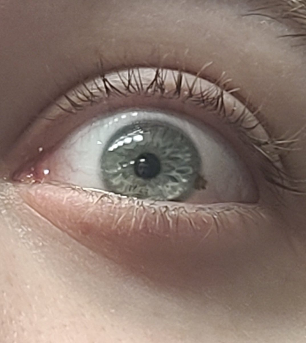 I have a freckle in my right eye