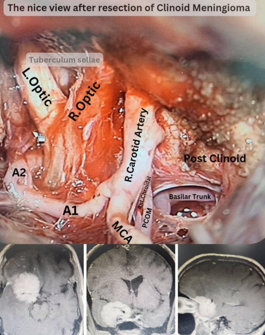GuiveSharifi's tweet photo. The Nice view after total resection of Clinoid Meningioma in 70 y/o male presented with headache and memory disorder.

#drguivesharifi 
#neurosurgeon 
#neurosurgery 
#braintumor #meningioma https://t.co/lwse0QAI3p