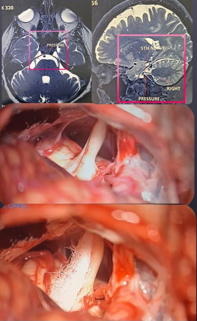 GuiveSharifi's tweet photo. Trigeminal Neuralgia in 56 y/o female with Pain in Right side of her face specifically in V3 branch. 
The fifth nerve has been released and covered by a piece of Teflone. 

#drguivesharifi 
#neurosurgeon 
#neurosurgery 
#braintumor #meningioma #trigeminal_nerve 
#neuralgia https://t.co/hfR9L6D25W
