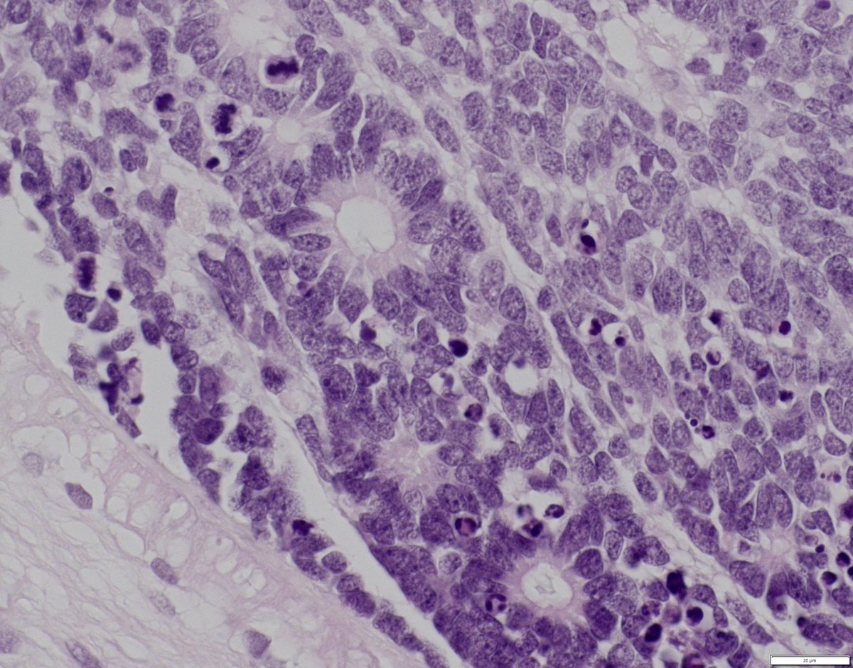 bitar_mireille's tweet photo. Intraocular mass in a child, diagnosis? Pathogenesis?
#pedipath #pathology
#eyepath #neuropath https://t.co/GyOCNF7iCd