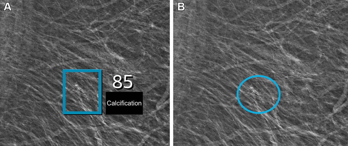 Radiology (@radiology_rsna) on Twitter photo Implementation of AI reduced the workload of breast radiologists and improved screening performance in a regional Danish population-based breast cancer screening program. <a href="/RegionH/">Region Hovedstaden</a> <a href="/MLSectionUCPH/">Machine Learning Section @UCPH</a> <a href="/uni_copenhagen/">University of Copenhagen</a> <a href="/andefader/">Andreas David Lauritzen</a> bit.ly/3yK3O2D Implementation of AI reduced the workload of breast radiologists and improved screening performance in a regional Danish population-based breast cancer screening program. <a href="/RegionH/">Region Hovedstaden</a> <a href="/MLSectionUCPH/">Machine Learning Section @UCPH</a> <a href="/uni_copenhagen/">University of Copenhagen</a> <a href="/andefader/">Andreas David Lauritzen</a> bit.ly/3yK3O2D