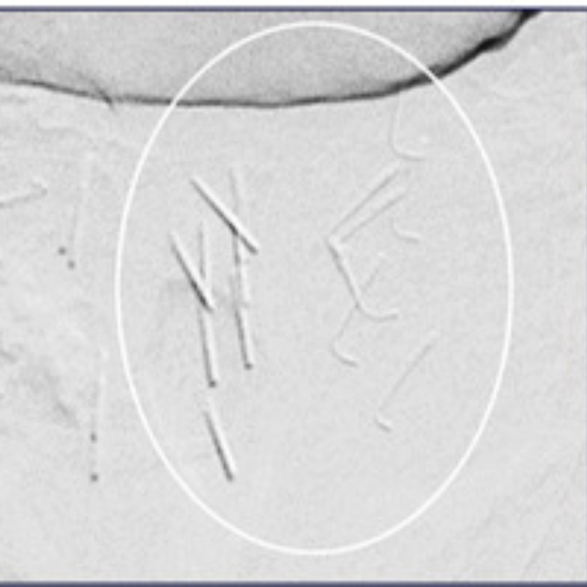 This #MensHealthMonth, <a href="/JVIRmedia/">JVIR</a> is making Prostatic Artery Embolization in Patients with Refractory Lower Urinary Tract Symptoms after a Prior Minimally Invasive Surgical Treatment free to read! brnw.ch/21wKwdm