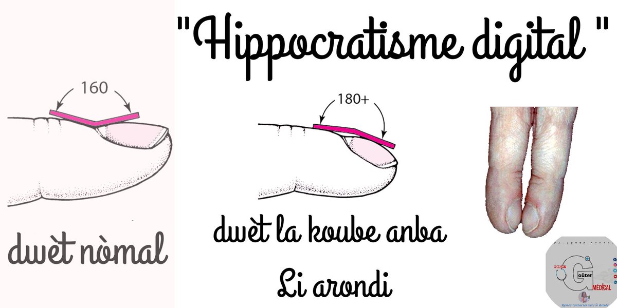 Docteur_Perrin's tweet photo. 📌 Èske n te konnen "Hippocratisme digital"
Se yon defòmasyon kote do zong lan koube vè pati pla men ou pye an, avèk pwent dwèt yo awondi. Gen de seri maladi ki ka lakoz li, konsa tou li kapab ereditè. E jiskaprezan poko gen yon tretman espesifik pou li, tou depan de koz li a. https://t.co/UnzSUuVJoJ