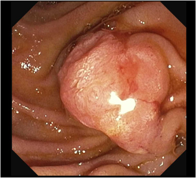 VideoGIE Journal (@videogie) on Twitter photo An Original Article by Netanel Zilberstein describes "Characterizing the extent and morphology of intraductal mucinous biliary neoplasm using a novel cholangioscope and treatment with ampullectomy." videogie.org/article/S2468-…
<a href="/NatiZilberstein/">Nati Zilberstein</a> <a href="/NealMehtaMD/">Neal Mehta</a>
<a href="/KaraRaphael/">Kara Raphael</a> An Original Article by Netanel Zilberstein describes "Characterizing the extent and morphology of intraductal mucinous biliary neoplasm using a novel cholangioscope and treatment with ampullectomy." videogie.org/article/S2468-…
<a href="/NatiZilberstein/">Nati Zilberstein</a> <a href="/NealMehtaMD/">Neal Mehta</a>
<a href="/KaraRaphael/">Kara Raphael</a>