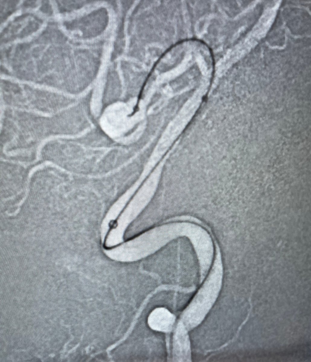 PenNeuro's tweet photo. US HCPs: #MIDWAY 43 tracking to V3 segment to stabilize management of large PICA aneurysm with #PXSlim and #PC400 coils. System supported by #BMK071. Courtesy of Dr. Giuseppe Ammirati!
Rx only. Risk: https://t.co/hzWEQEPOqr Clinical results may vary https://t.co/pLKFanNgi7