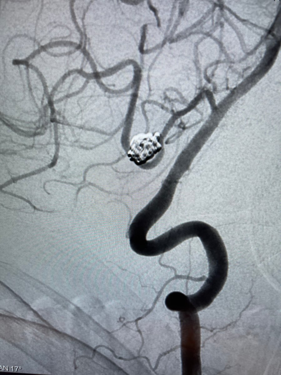 PenNeuro's tweet photo. US HCPs: #MIDWAY 43 tracking to V3 segment to stabilize management of large PICA aneurysm with #PXSlim and #PC400 coils. System supported by #BMK071. Courtesy of Dr. Giuseppe Ammirati!
Rx only. Risk: https://t.co/hzWEQEPOqr Clinical results may vary https://t.co/pLKFanNgi7