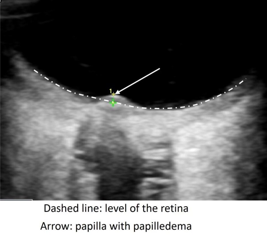 7irz's tweet photo. @dan___kim @gokpocus @SCCM @piergiorgioloc2 @CKrogias Agreed, if you look at the image below, the measurement should start from the dashed line "the level of the retina" and not the arrow "papilla" per expert consensus. https://t.co/dy87wJtDUF