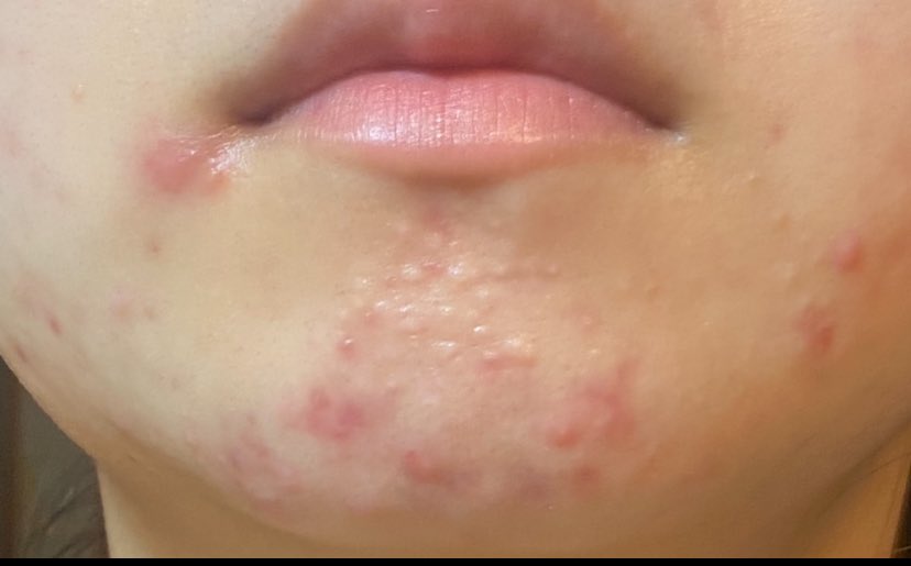 あーきたきた
顎にできやすいのどうにかして欲しい
口の真横でかすぎる