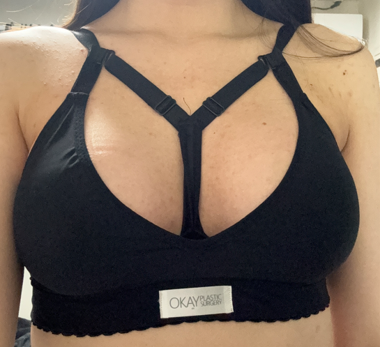 _aapplleee's tweet photo. 大きな痛みはないですが、乳首のあたりに痺れるような感覚が出てきました！
怖くなって病院に聞いてみたら感覚が戻ってきたとのことで一安心😃
包帯とむくみ防止用のトップバンドを外したんですがかなり楽になりました～👏🏻

#豊胸手術 #DT7日目 #チョンダムOK https://t.co/6DQlxqJ9bm