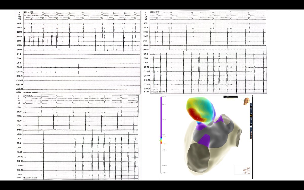 Benhur Davi Henz (@benhurhenz) on Twitter photo Long lasting persistent AF, previous PVI + posterior Wall. Now PV and posterior wall isolated. After some atrial debulking, reversion and AT reinduction with high atrial burden of LAA taquicardia- After LAA isolation high burden inside, w/<a href="/luizrleite/">Luiz Leite</a> <a href="/simoneeccosbr/">Simone Nascimento</a> andrezanatta Long lasting persistent AF, previous PVI + posterior Wall. Now PV and posterior wall isolated. After some atrial debulking, reversion and AT reinduction with high atrial burden of LAA taquicardia- After LAA isolation high burden inside, w/<a href="/luizrleite/">Luiz Leite</a> <a href="/simoneeccosbr/">Simone Nascimento</a> andrezanatta