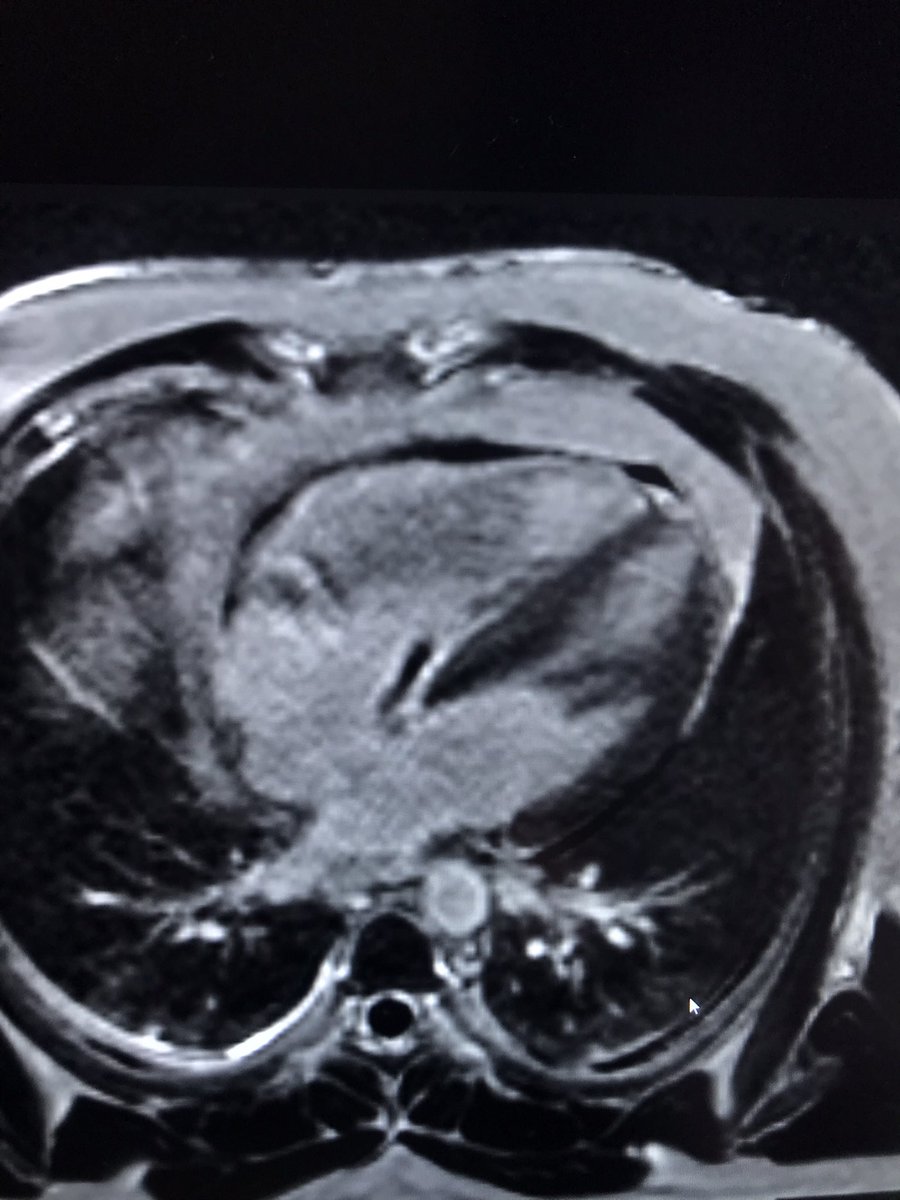 GrublerMartin's tweet photo. 29 y/o male referred to #CMR for susp of atrial mass.
Turned out to be #Thrombus stuck somewhere between rete chiari and coronary sinus ostium
#whyCMR #CMRfirst
He had a #DVT 2 weeks prior and is on anticoagulation @saramoscatelli7
@rmanka_ @GTersalv https://t.co/fbiA4ridcN