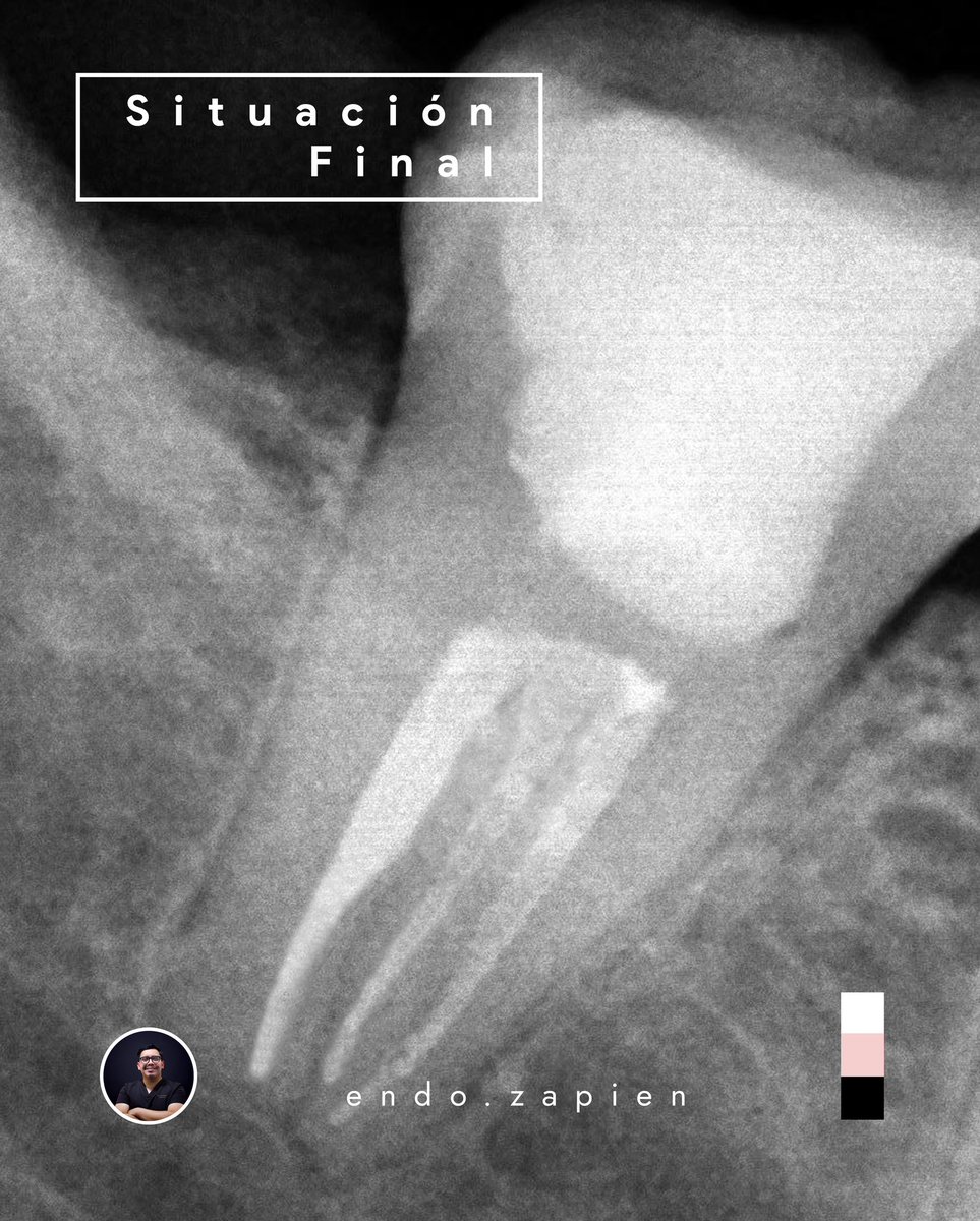 endozapien's tweet photo. Durante la exploración clínica y el acceso se determinó que este material tenía todas las características del MTA. Se retiró con puntas de ultrasonido diamantadas (bendito ultrasonido)  y se localizaron los conductos faltantes. https://t.co/7DX5KfI4ih