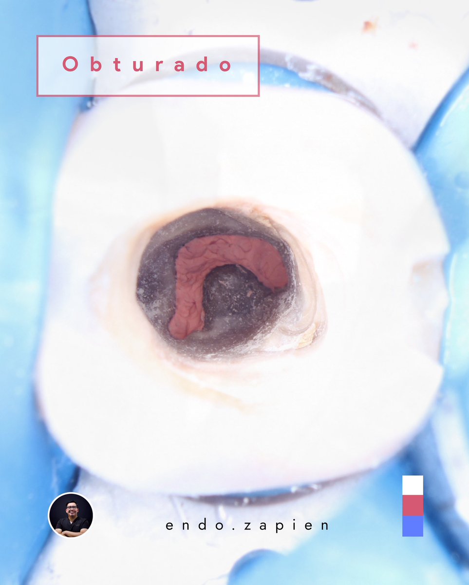 endozapien's tweet photo. Durante la exploración clínica y el acceso se determinó que este material tenía todas las características del MTA. Se retiró con puntas de ultrasonido diamantadas (bendito ultrasonido)  y se localizaron los conductos faltantes. https://t.co/7DX5KfI4ih