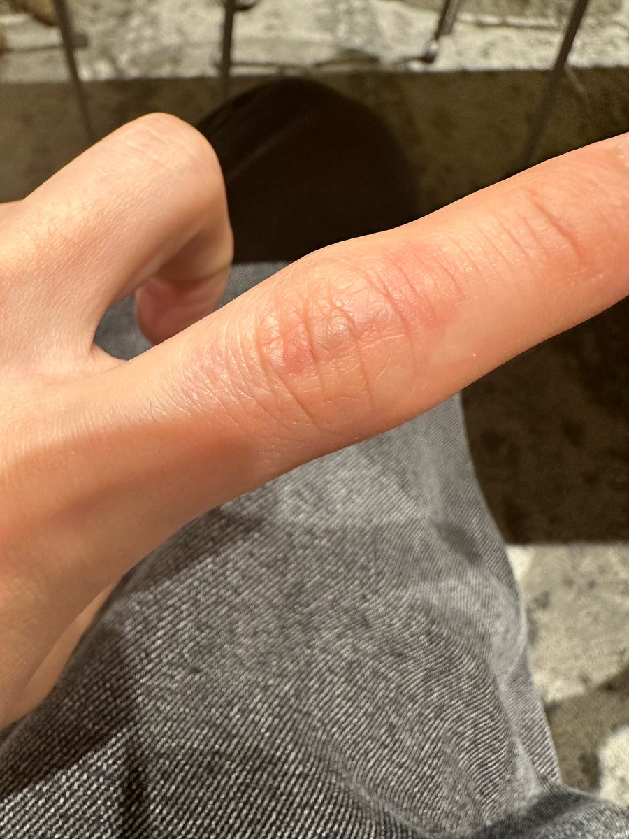skzwithstay8's tweet photo. 🐰- 🌱 
[070624] 1:18 PM KST

*picture

Ha..mosquito 

It’s itchy https://t.co/kIzKCkEHC0
