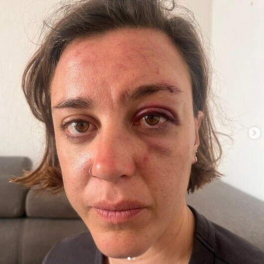 💬 «J’étais avec ma petite amie dans une rue assise sur un trottoir, on discutait, on se faisait un câlin, et c’est là qu’un homme a commencé à se moquer de nous»

Laura dénonce son agression lesbophobe par «quatre à cinq hommes» à Montpellier 
➡️ l.leparisien.fr/hEVp