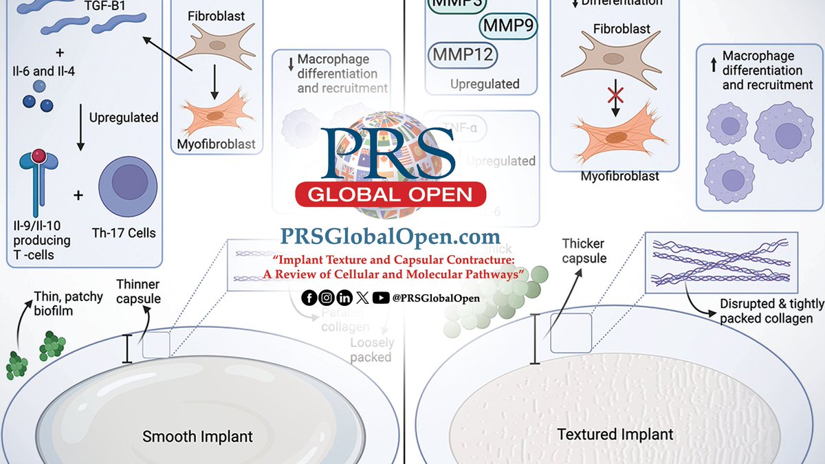 PRSGlobalOpen's tweet photo. The May 2024 compendium of #PRSGlobalOpen is available NOW!
Read articles like "#ImplantTexture and #CapsularContracture: A Review of Cellular and Molecular Pathways" by Wells, Yang, Edelstein-Keshet, and Isaac: https://t.co/Eo7JgxK8L4 https://t.co/cM2MnTiIEU