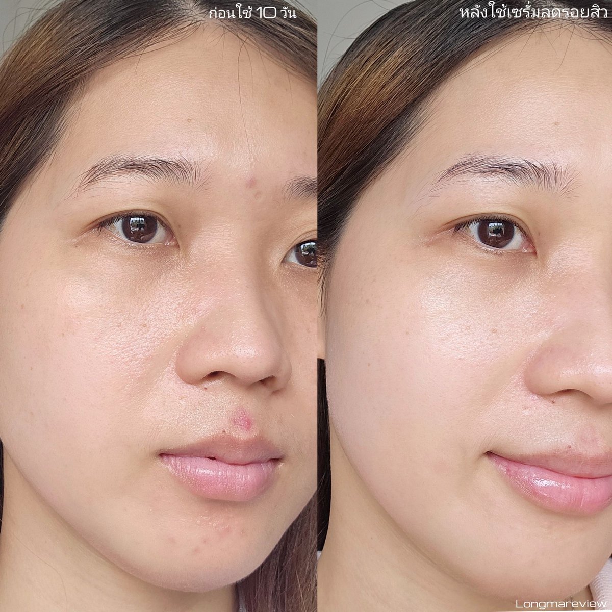 Longmareview's tweet photo. นี่ขึ้นหลอดสอง​ เซรั่มสยบรอยสิวต้องตัวนี้จิงๆ​👍🏻 Eucerin Anti-Acne Mark Serum มีไทอามิดอลช่วยตัดตอนลดรอยสิวฝังลึกถึงจุดกำเนิด​ เราเริ่มใช้น้องเค้าตั้งแต่สิว��ุด พอสิวหายแทบไม่ทิ้งรอยสิวไว้เลย​ เวิร์คมากกก​ รอยสิวเก่าๆก็จางลง​ ตอนทามันจะเย็นๆผิวหน่อย​ แต่ไม่แสบไม่ลอก​ คุมมันบนหน้าดี​ สิวอุดตันค่อยน้อยลง​ ละ​ ไม่ค่อยเกิดซ้ำด้วย​ หน้าดีขึ้นคือเริ่ดด​#EucerinThailand #ใช้ดีบอกต่อ #EucerinAntiAcneMark