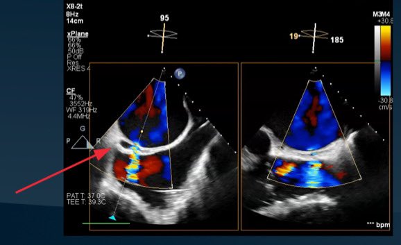 Leila Haghighat, MD MPhil (@leilahaghighat) on Twitter photo Come check out how we managed a challenging case of interatrial septal dissection and hematoma at #NYValves2024! <a href="/crfheart/">Cardiovascular Research Foundation</a>
📣 Complex Cases with Masters series
⏰ 10:30 am, 5th floor Innovation Hub Come check out how we managed a challenging case of interatrial septal dissection and hematoma at #NYValves2024! <a href="/crfheart/">Cardiovascular Research Foundation</a>
📣 Complex Cases with Masters series
⏰ 10:30 am, 5th floor Innovation Hub