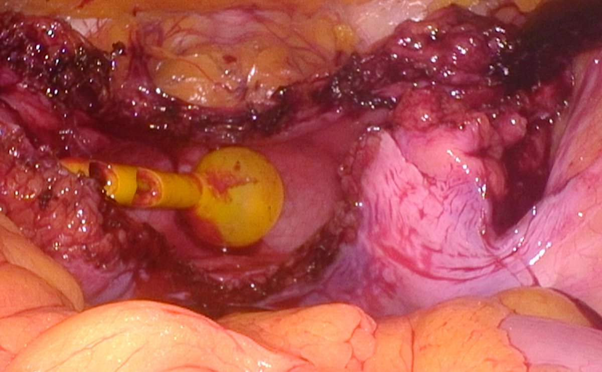 DrVCMohan's tweet photo. https://t.co/wnwLhiOP2l

Post GUTB thimble bladder
Robotic assisted Augmentation Ileocystoplasty (SSI MANTRA)
24cm ileal U patch used
Bivalving of bladder done, bladder neck anteriorly to inter-ureteric bridge posteriorly 
For safety SPC kept
Post op cystogram @ 3 wks shows good capacity 
Sharing the video

https://t.co/wnwLhiOP2l