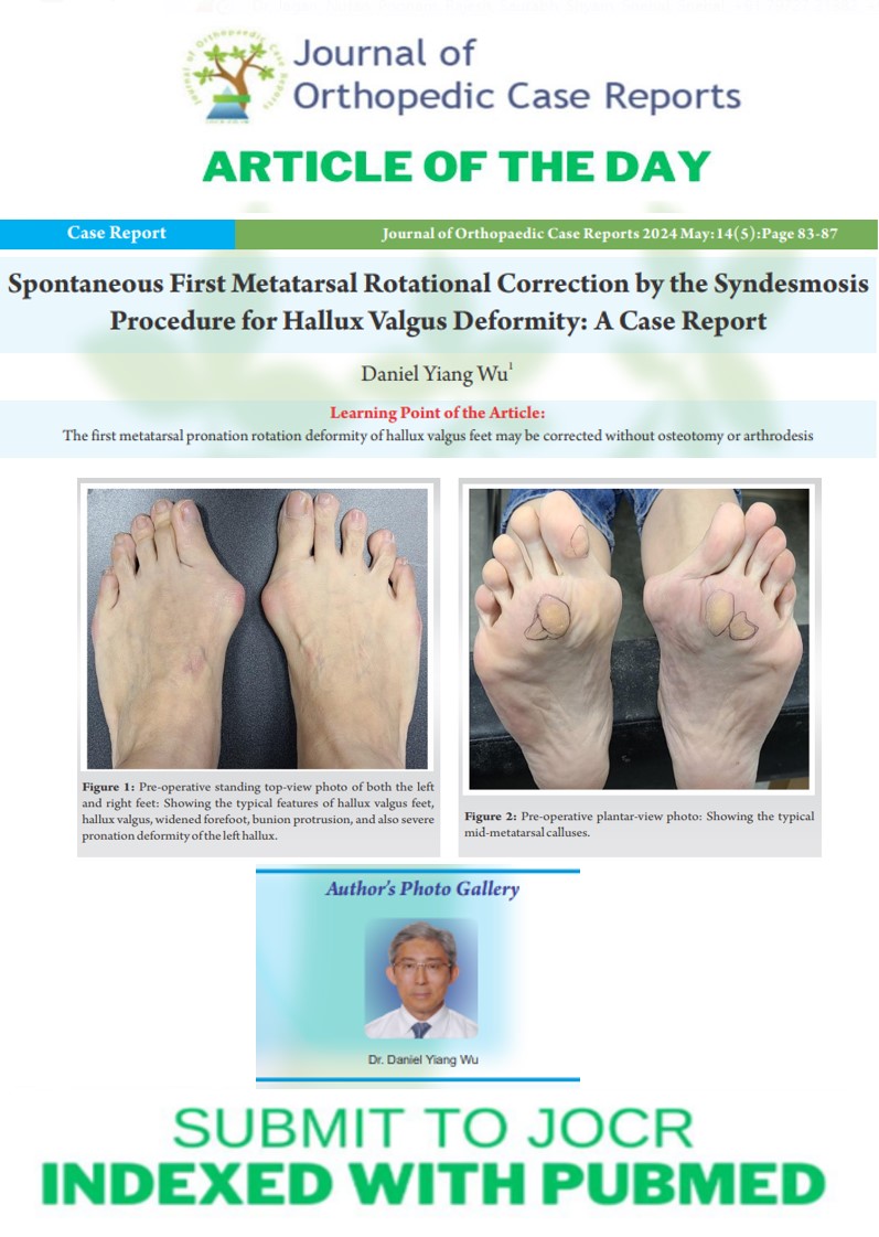 Ortho_Updates's tweet photo. 🔰JOCR Article of the Day: Spontaneous First Metatarsal Rotational Correction by the Syndesmosis Procedure for Hallux Valgus Deformity: A Case Report
https://t.co/QviQZYM7Tv

✅JOCR Now accepting Original Articles and Case series too– https://t.co/PtndWJ5zI5 https://t.co/gl3gA0Assa
