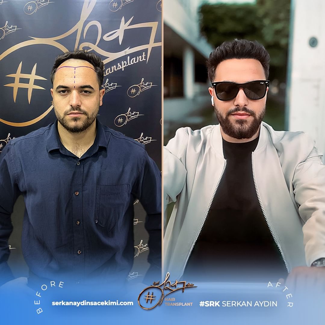 Arenamedd's tweet photo. Noch ein perfektes Ergebnis 😎
#musagüngör
Kontaktieren Sie uns für kostenlos Haaranalyse 📱

#serkanaydin #maximumgrafts #hairtransplant #beardtransplant #stemcell #haartransplant #Stammzellen #maximalgraft #maximaktransplantation https://t.co/Ec4XnB4g4a
