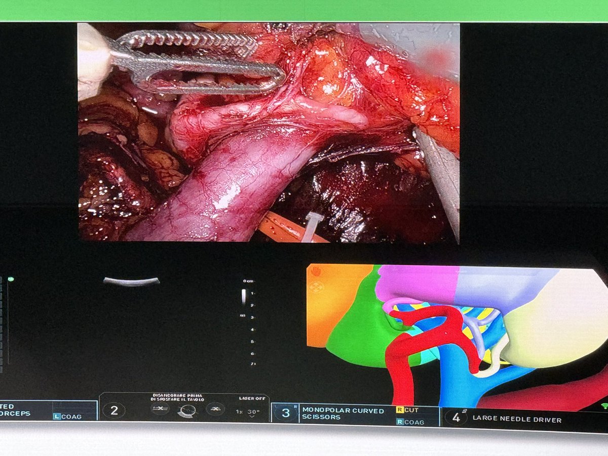 DrOrcunCelik's tweet photo. 3D modelling for robotic partial nephrectomy to perform selective artery clamping 👍👍👍
@CILR2024 
#robotic partial nephrectomy https://t.co/Wpyx5teaBU