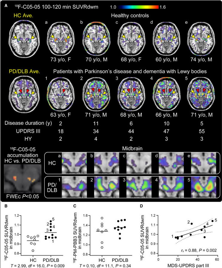 Oooh interesting: Introducing C05-05, a small-molecule ligand for imaging α-synuclein pathologies in animal models and patients with #Parkinsons &amp; related diseases; PET-detectable signals were intensified in the midbrains of PD &amp; DLB patients (vs controls)
cell.com/neuron/fulltex…