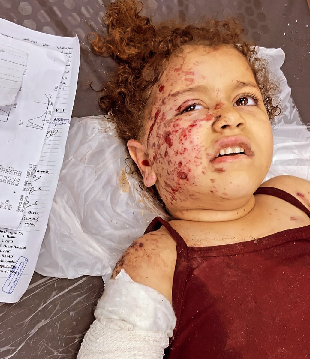 hamad_alnajjar's tweet photo. Terörist İsrail'in saldırılarında yaralanan küçük Gazzeli kız Şahed Rıdvan

Gazze'yi unutma unutturma Soykırım devam ediyor https://t.co/dqPIQV7G49