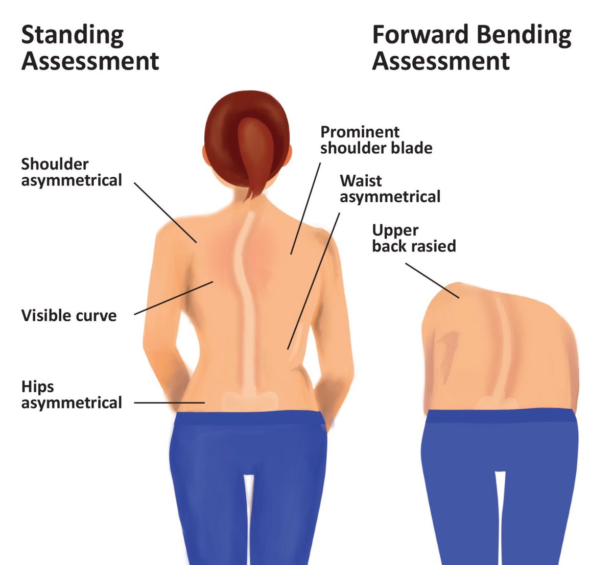 Fatima2_sharif's tweet photo. Today, I raise awareness on Scoliosis.

Scoliosis is a spinal condition when there is curvature of the spine to a ‘c’ or ‘s’ shape. It affects anyone, regardless of age, If left untreated, can lead to serious health risks, such as respiratory problems and chronic pain. https://t.co/zKl2nSyPhR